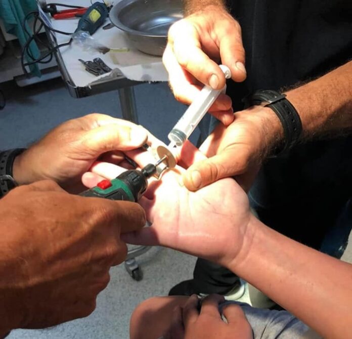 Αφαιρέθηκε με ασφάλεια από τη ΛΕΔ ρουλεμάν από παιδικό δάχτυλο (ΦΩΤΟ – VIDEO)