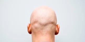 Βρετανία: Σεξιστικά τα σχόλια για την φαλάκρα αν γίνονται στον χώρο εργασίας