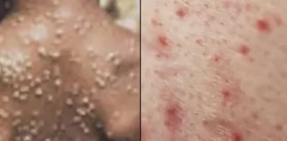 Εμφανίστηκε το πρώτο κρούσμα της ευλογιάς των πιθήκων στην Ελλάδα!