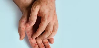 Σχεδόν 100 κρούσματα ιλαράς μέσα λίγες εβδομάδες στο Τέξας και το Νέο Μεξικό