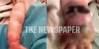 Βόλος: Χειρουργήθηκε το βρέφος που έπαθε σοβαρά εγκαύματα στο χέρι από ενδοφλέβιο ορό – «Όπως μας λένε οι γιατροί καλά πάει»