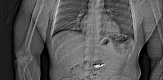 Κλέφτης κατάπιε σκουλαρίκια 750.000 δολαρίων λίγο πριν συλληφθεί