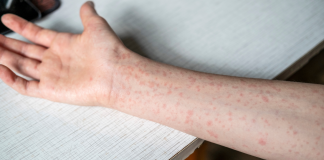 Δεύτερο κοριτσάκι πεθαίνει από ιλαρά στις ΗΠΑ