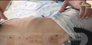 “Θρίλερ” με το 10χρονο αγόρι που μεταφέρθηκε στο Καραμανδάνειο με ύποπτα σημάδια στην πλάτη του – Εγκαύματα τριβής ή κακοποίηση;