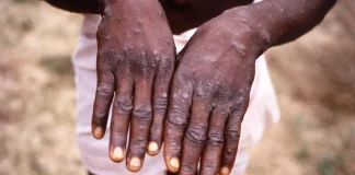 Πρώτος θάνατος στη Γκάνα εξαιτίας της επιδημίας mpox