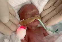 Γερμανία: Γιατροί κατάφεραν να κρατήσουν στη ζωή πρόωρο μωρό που ζύγιζε μόλις 300 γραμμάρια! – Δείτε φωτογραφίες