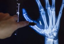 Μιζούρι: Εμφύτευσε τσιπ στο χέρι του και ξέχασε τον κωδικό