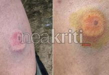 Ηράκλειο: Αγρότες στο νοσοκομείο με τραύματα από πλαστικές σφαίρες