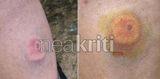 Ηράκλειο: Αγρότες στο νοσοκομείο με τραύματα από πλαστικές σφαίρες