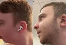 Ο άνθρωπος που υποβλήθηκε σε διπλή επέμβαση γνάθου: Η μεγάλη αλλαγή στην εμφάνισή του