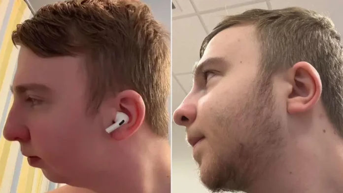 Ο άνθρωπος που υποβλήθηκε σε διπλή επέμβαση γνάθου: Η μεγάλη αλλαγή στην εμφάνισή του