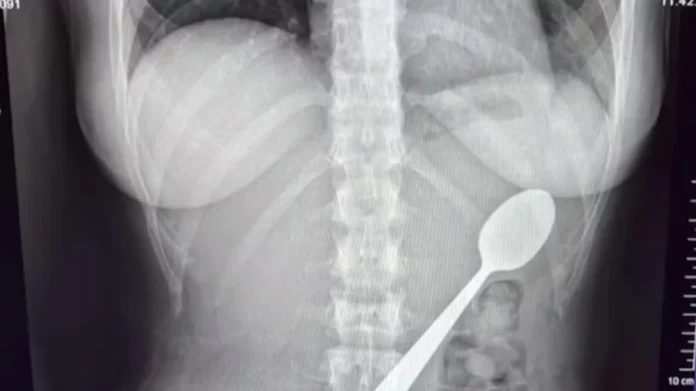 Μια 28χρονη στο Βέλγιο κατάπιε κουτάλι 17 εκατοστών όταν πήδηξε πάνω της ο σκύλος της