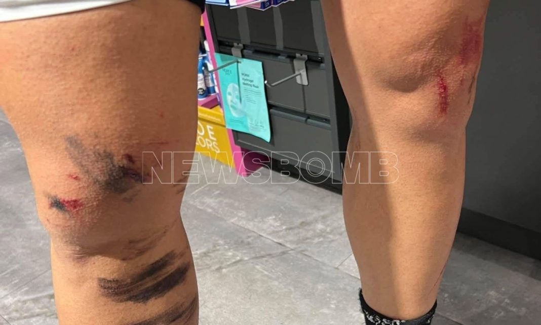 Κρυονέρι: Άγρια επίθεση λύκου σε κάτοικο - «Πάλευα για τη ζωή μου 8 λεπτά»
